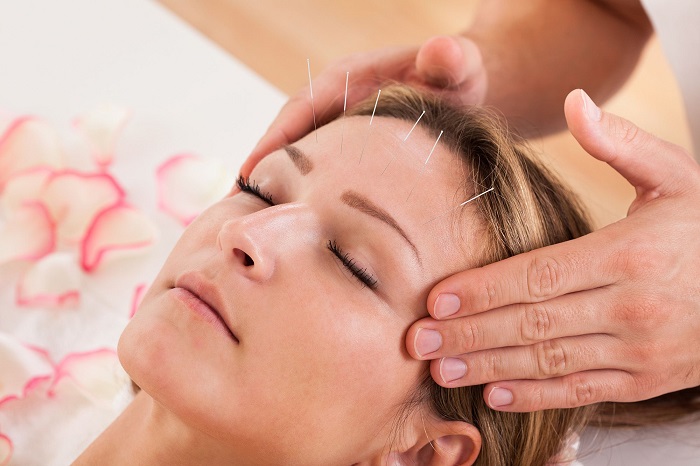 Does Acupuncture Help People With Medication Overuse&nbsp;Headaches